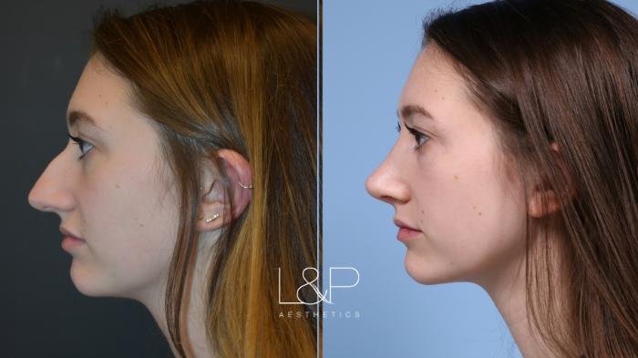 Stunning Rhinoplasty for young woman