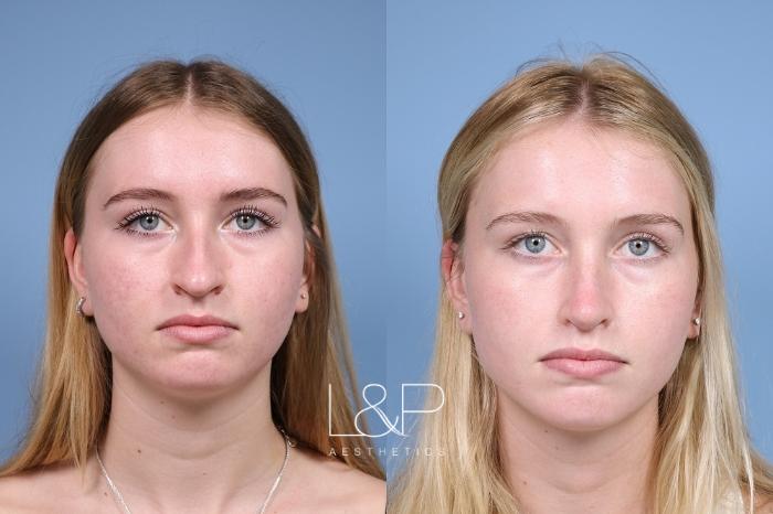 Rhinoplasty Results Can Be Complicated To Perform In A Way That Will ...