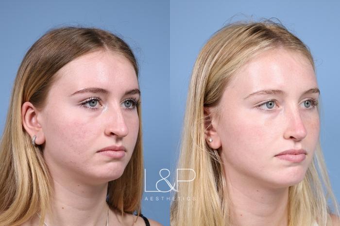 Rhinoplasty Results Can Be Complicated To Perform In A Way That Will Give The Patient Facial