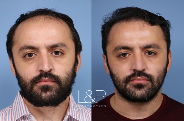 L&P Male Rhinoplasty & Hair Transplant
