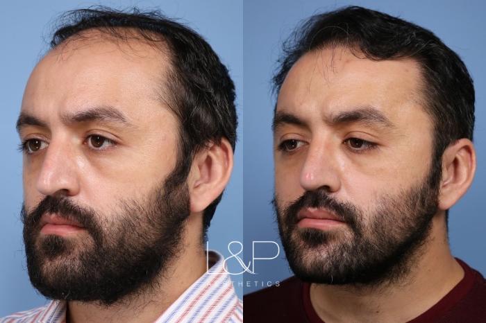 L&P Male Rhinoplasty & Hair Transplant