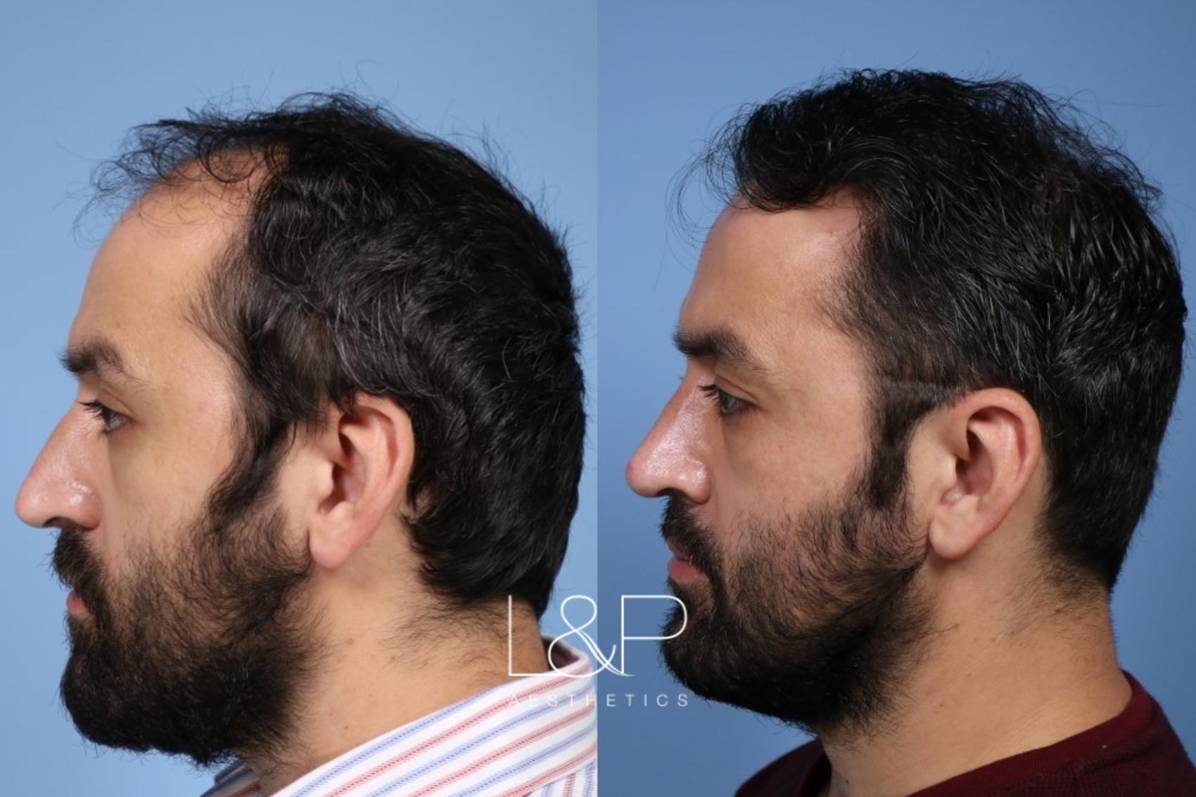 L&P Male Rhinoplasty & Hair Transplant