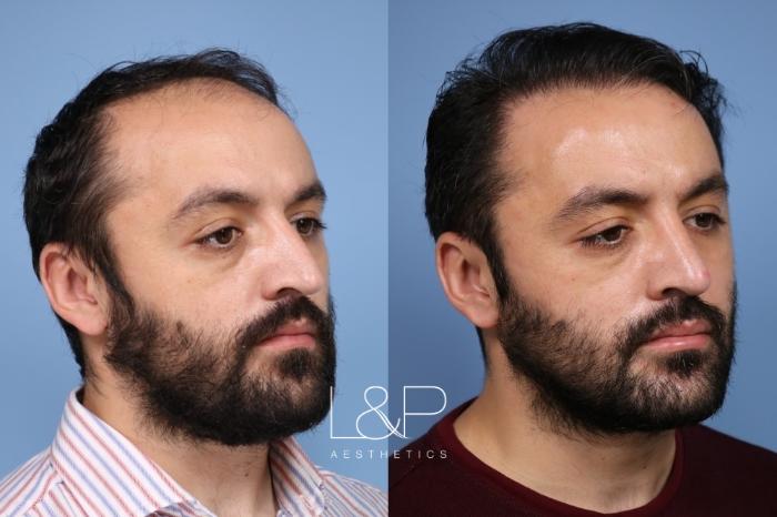L&P Male Rhinoplasty & Hair Transplant