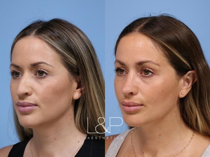 Dramatic rhinoplasty result with a nose that is more form fitting to her face