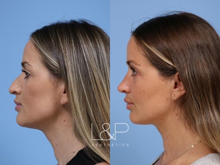 Dramatic rhinoplasty result with a nose that is more form fitting to her face