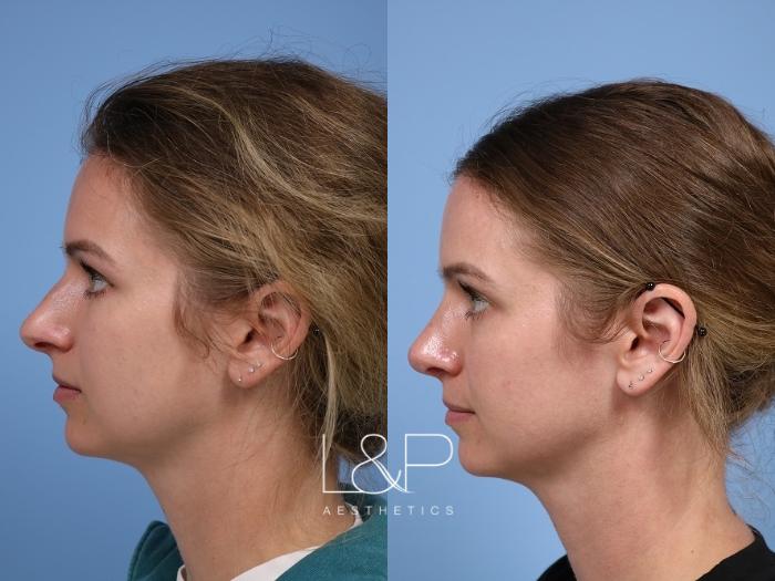 Young woman undergoes Rhinoplasty