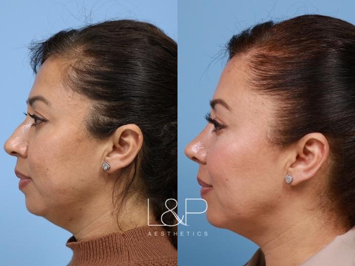 Three procedure combination for facial balancing effect