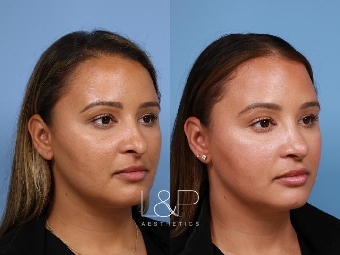 Rhinoplasty and Septoplasty Case for Bay Area Woman