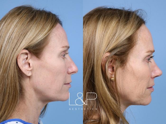 Rhinoplasty and Lip Lift Case for Bay Area Woman