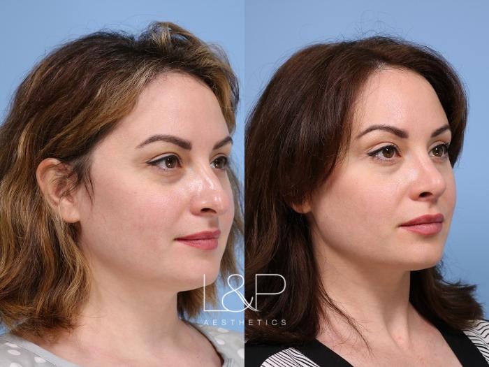 Stunning Nose Transformation for Facial Balance