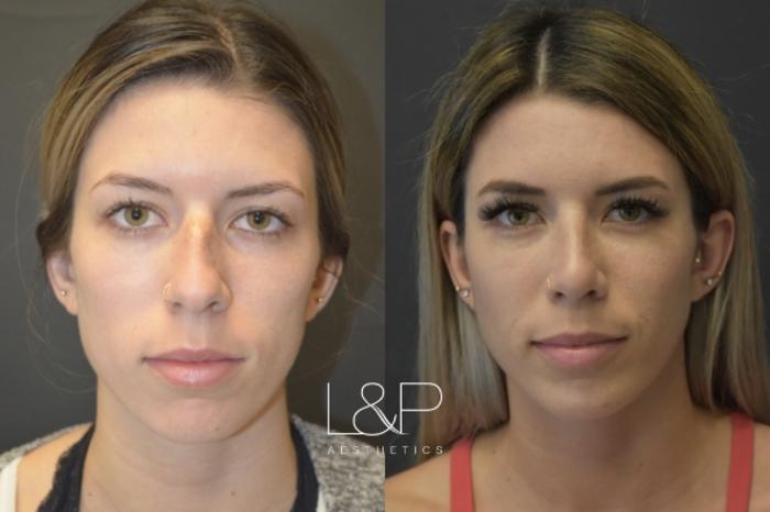 Before & After Rhinoplasty Case 48 Front View in Palo Alto & San Jose, California