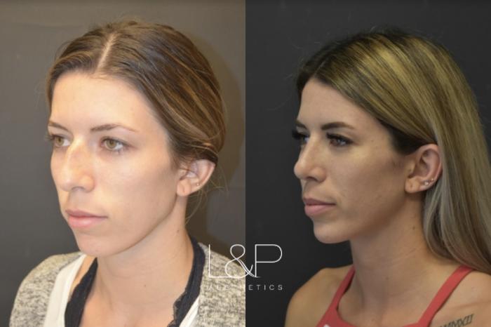 Before & After Rhinoplasty Case 48 Left Oblique View in Palo Alto & San Jose, California