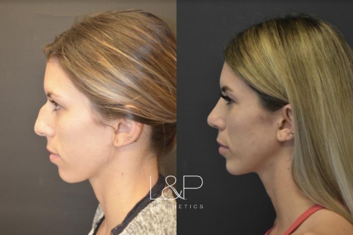 Before & After Rhinoplasty Case 48 Left Side View in Palo Alto & San Jose, California