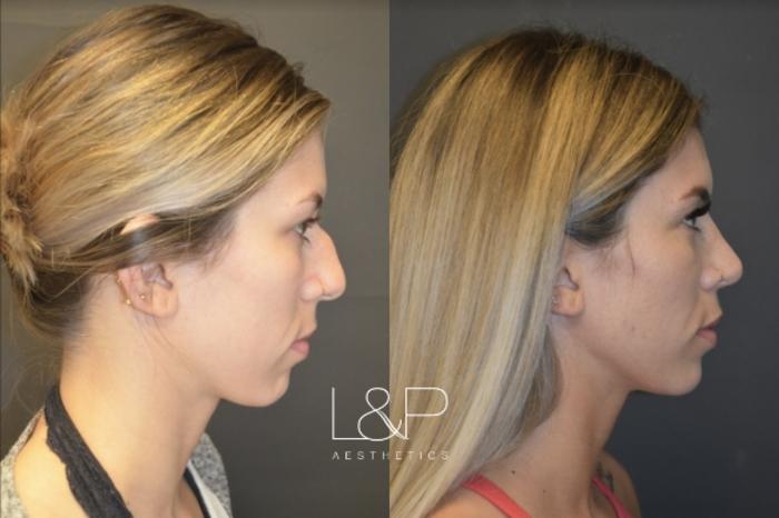 Before & After Rhinoplasty Case 48 Right Side View in Palo Alto & San Jose, California