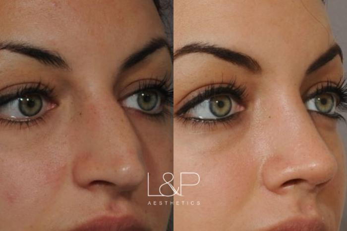 Before & After Rhinoplasty Case 50 Front View in Palo Alto & San Jose, California