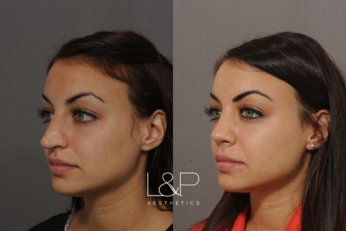 Before & After Rhinoplasty Case 50 Left Oblique View in Palo Alto & San Jose, California