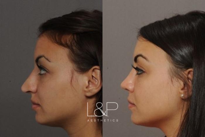 Before & After Rhinoplasty Case 50 Left Side View in Palo Alto & San Jose, California