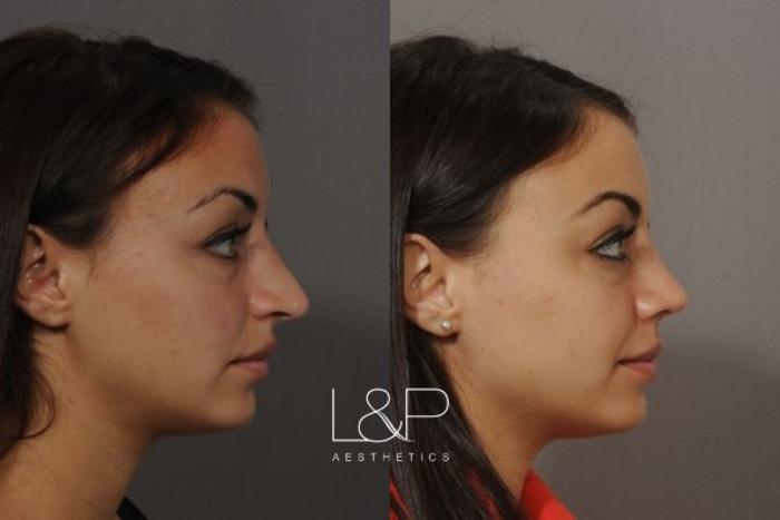 Before & After Rhinoplasty Case 50 Right Side View in Palo Alto & San Jose, California
