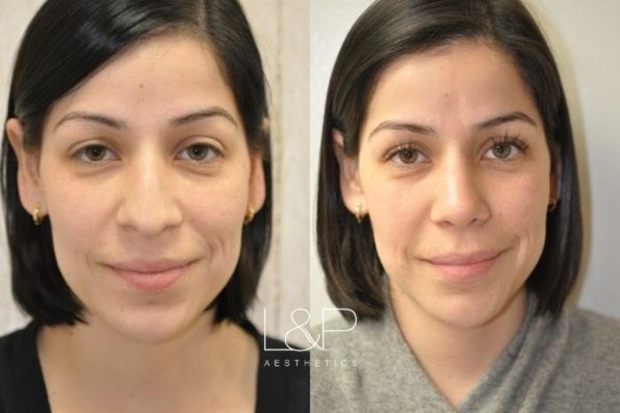 Before & After Rhinoplasty Case 53 Front View in Palo Alto & San Jose, California