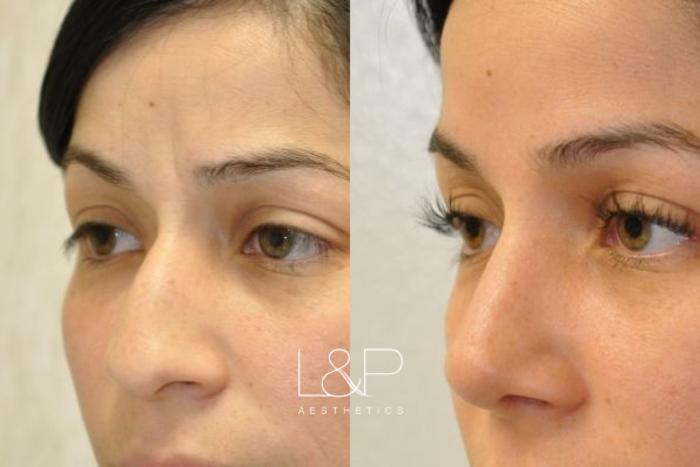 Before & After Rhinoplasty Case 53 Left Oblique View in Palo Alto & San Jose, California