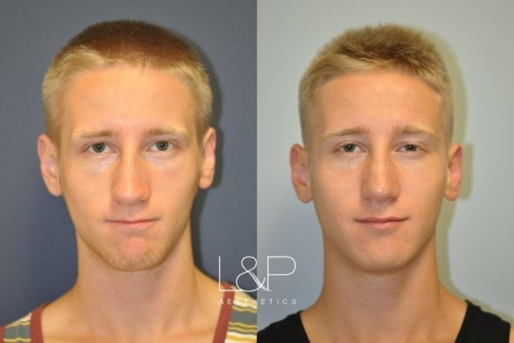 Rhinoplasty Before & After Photo Gallery | Palo Alto & San Jose ...